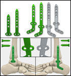 医疗器械 医疗钢板