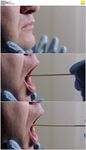 棉签擦嘴检验dna