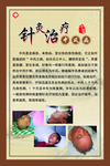 针灸治疗 中医 中风病 拔罐