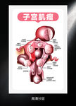 子宫肌瘤高清分层图