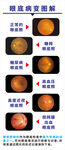眼底病变图解