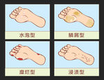 脚气类型