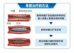 动脉硬化闭赛症导管治疗