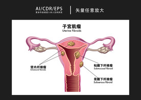 矢量医学子宫肌瘤图解插画