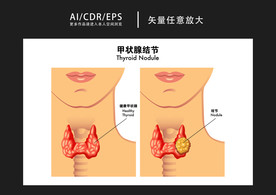 矢量医学甲状腺结节图解插画