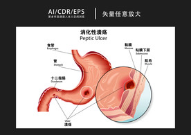 矢量医学消化性溃疡图解插画