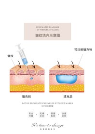 皱纹填充示意图
