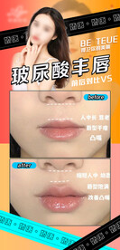 医美玻尿酸丰唇案例