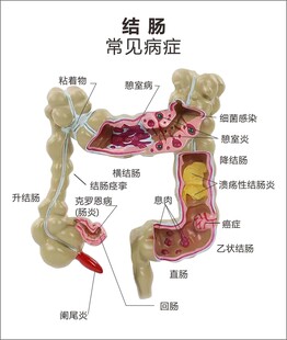 结肠常见病症解剖示意图