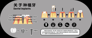 关于种植牙