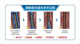 静脉曲张激光治疗